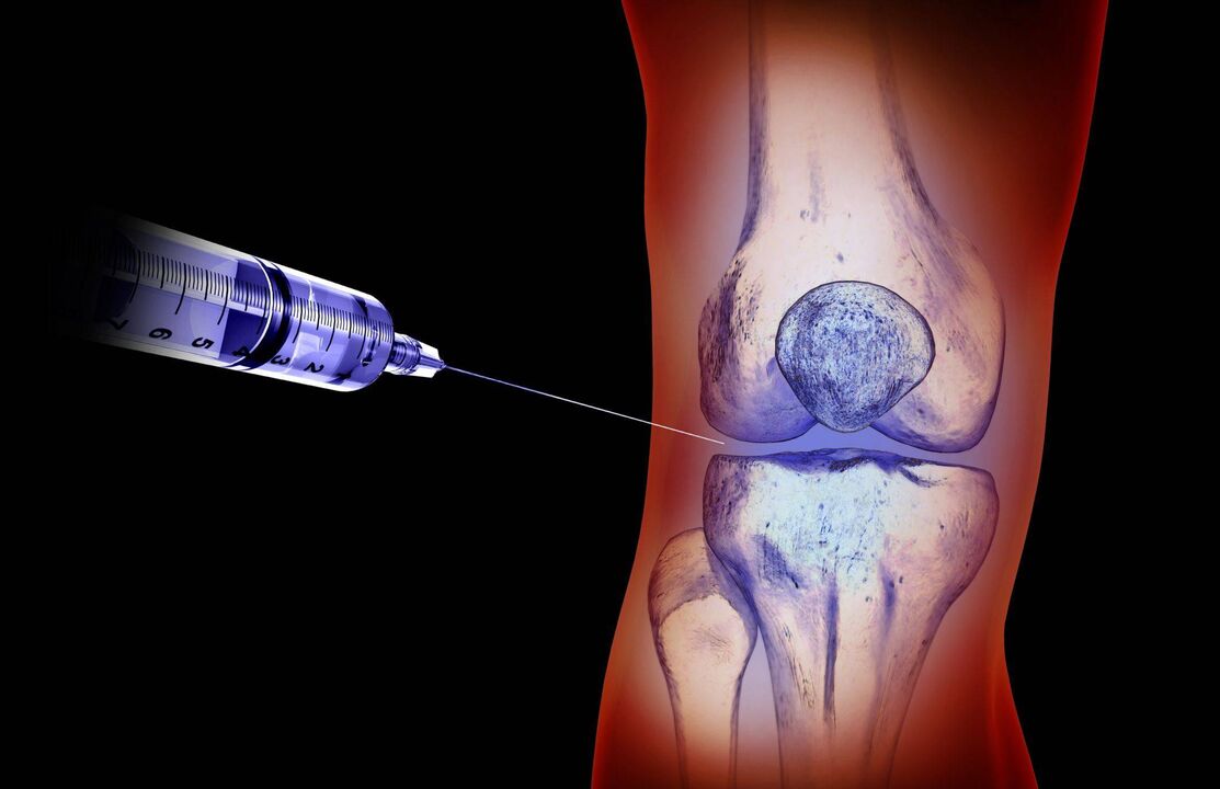 injections intra-articulaires pour l'arthrose