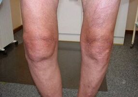 Comment traiter l'arthrose d'articulation du genou