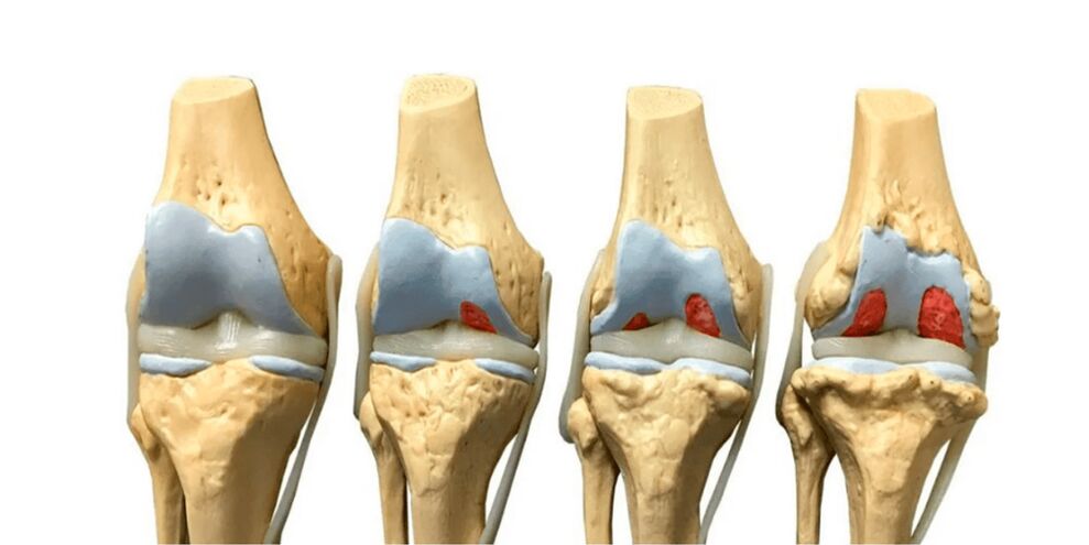 degré d'arthrose articulaire